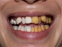 a before-and-after shot showing discolored and whitened teeth