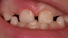 Chipped tooth repair in Springfield, MO