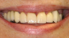 Porcelain veneers in Springfield, MO