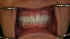 Chipped tooth repair in Springfield, MO