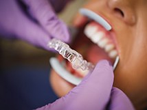 dentist putting clear aligner on patient 