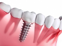 Diagram of dental implants in Springfield