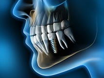 X-ray diagram of dental implants