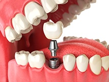 Diagram showing single tooth dental implant being placed