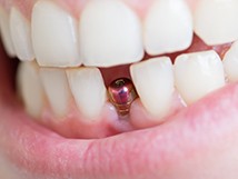 Closeup of patient’s mouth after dental implant surgery