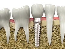 Diagram of dental implants during osseointegration