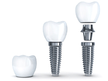 3D illustration of implant, abutment, and crown