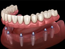 Implant dentures in Springfield 