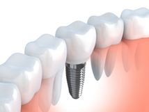 Illustration of a dental implant
