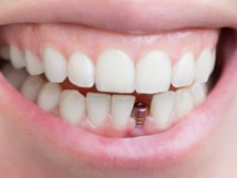 dental implant in place