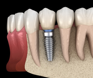 Illustration of a titanium dental implant in the lower jaw