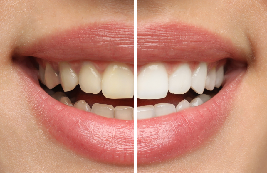 Close up of woman's smile with half white, half yellow teeth